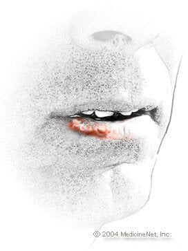 Herpes Simpleks